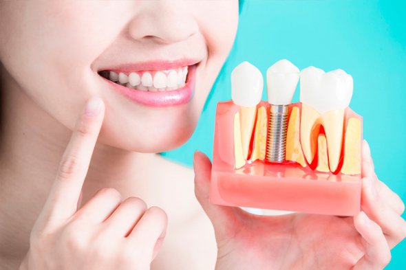 Основные преимущества качественных зубных имплантов