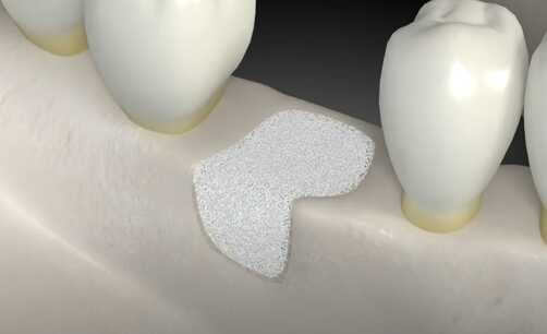 Зачем нужны услуги наращивания зубной кости